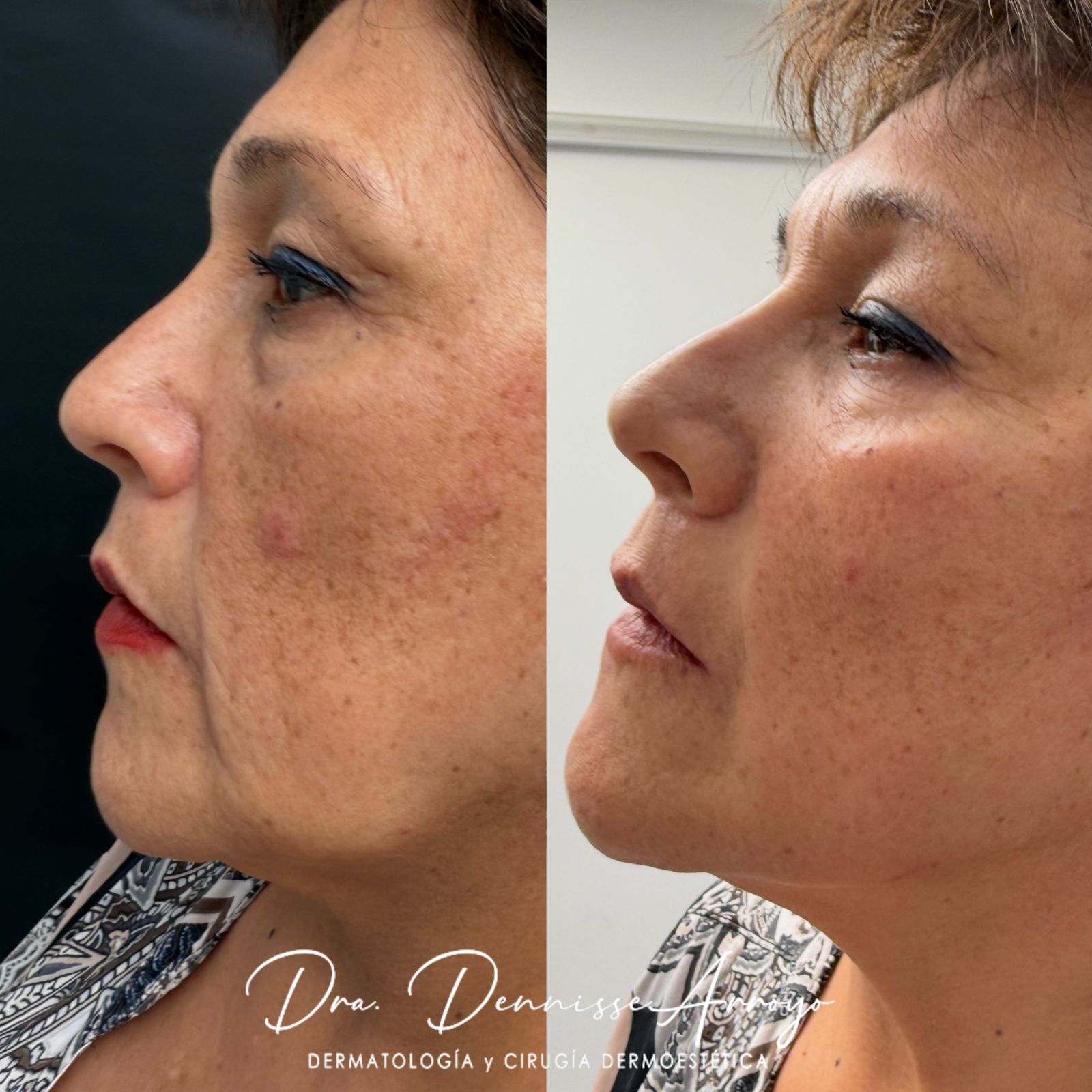 Neauvia Stimulate + Neauvia Hidrodeluxe