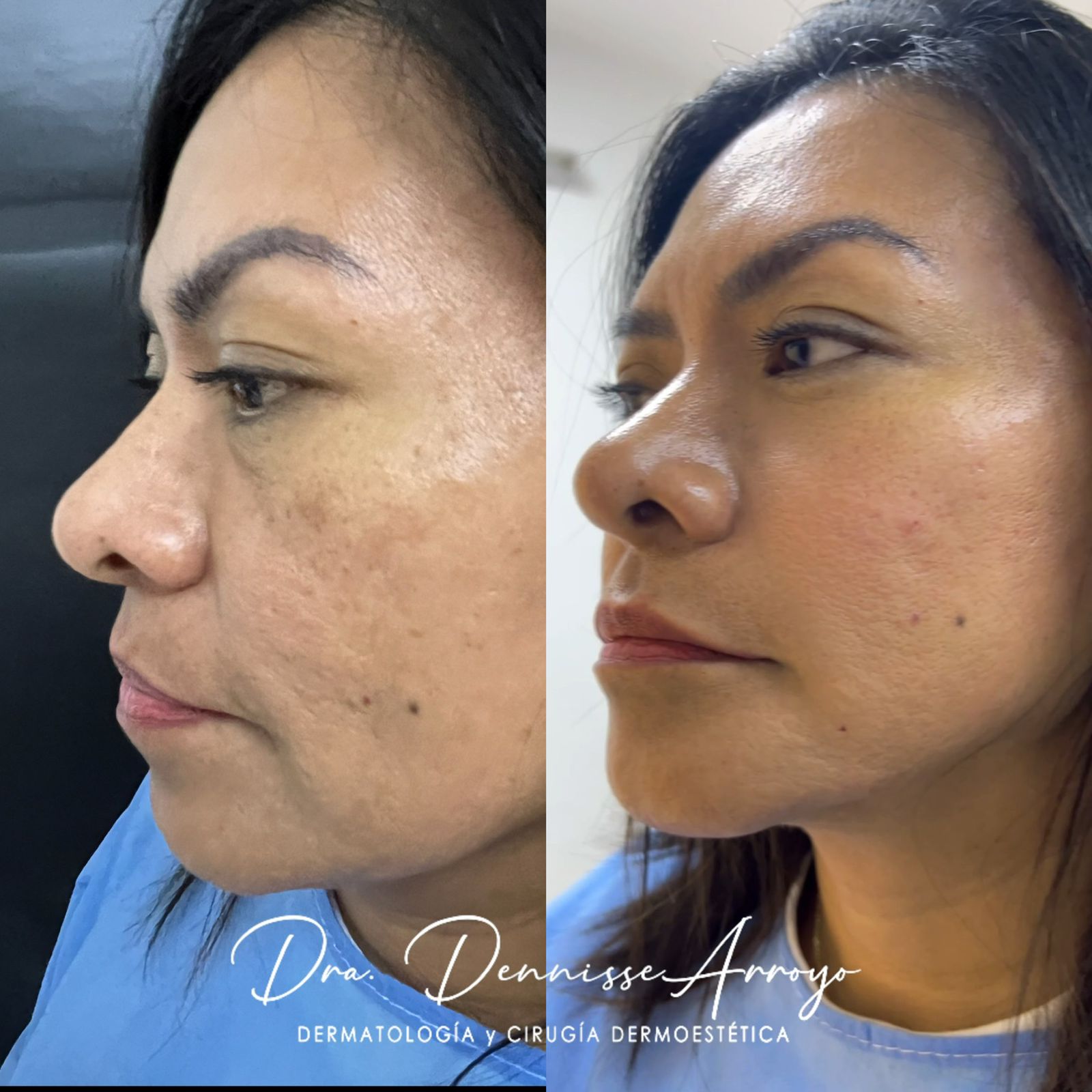 Contourlift - Tratamiento de rejuvenecimiento facial
