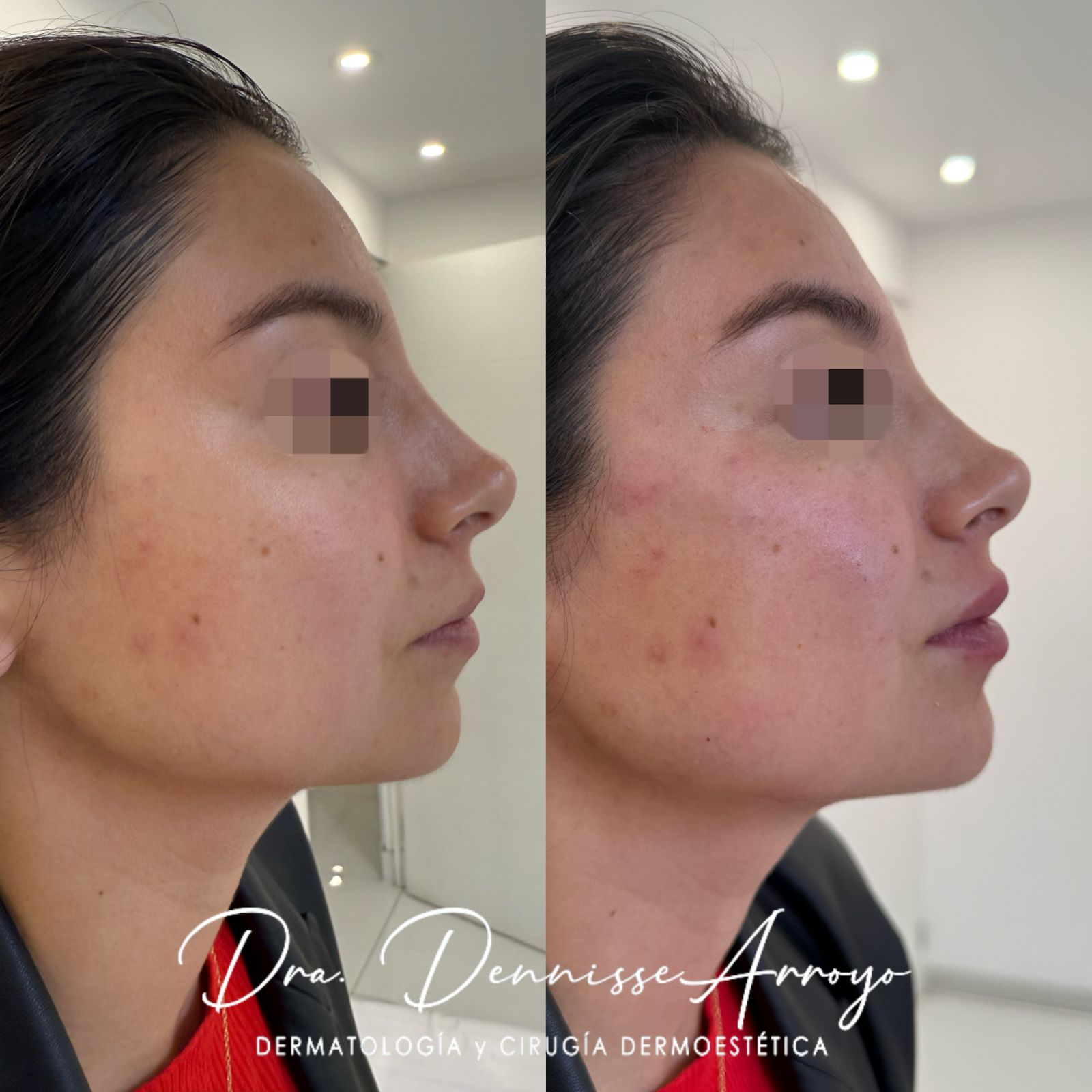 FaceModeling con Ácido Hialurónico - Tratamiento de rejuvenecimiento facial