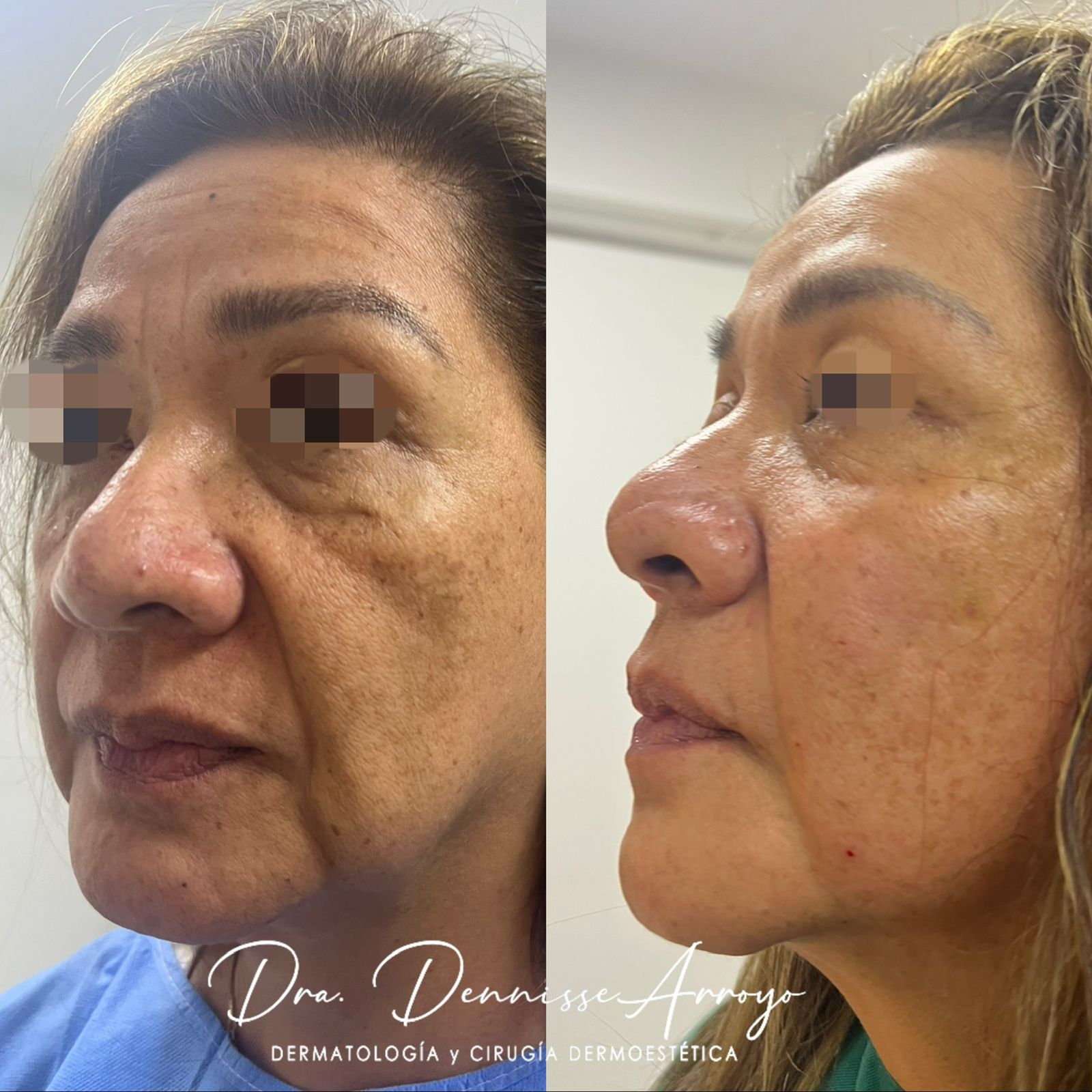 Glow Skin Lifting - Tratamiento de rejuvenecimiento facial