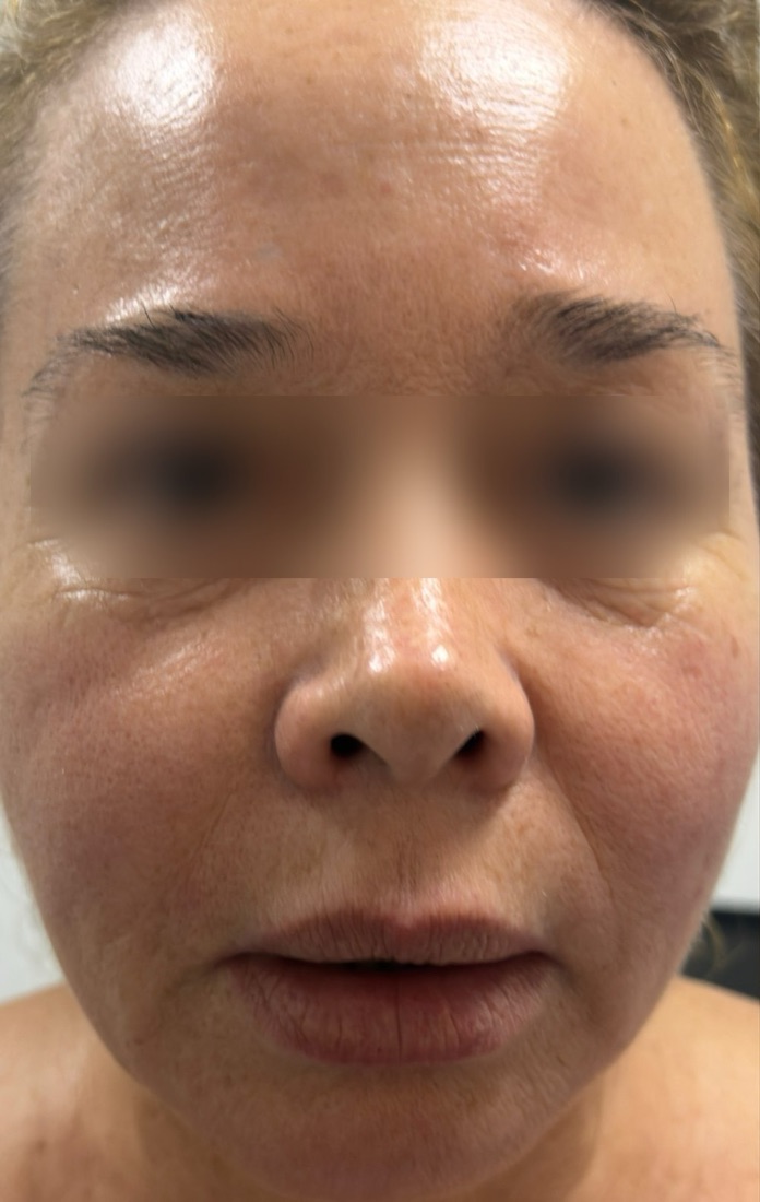 Paciente antes del Spanish Contour Lift, vista frontal, con los ojos cubiertos
