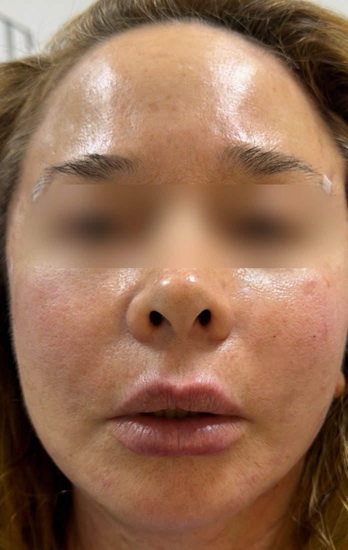 La misma paciente después del Spanish Contour Lift con la Dra. Dennisse Arroyo: pómulos con más soporte y contorno mandibular más definido
