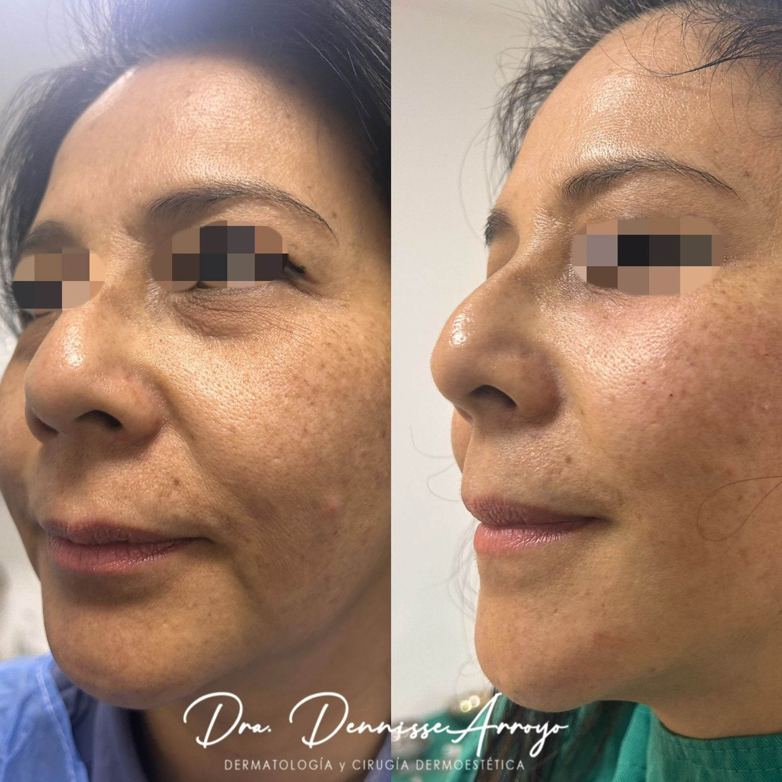 Reshape Facial® - Tratamiento de rejuvenecimiento facial